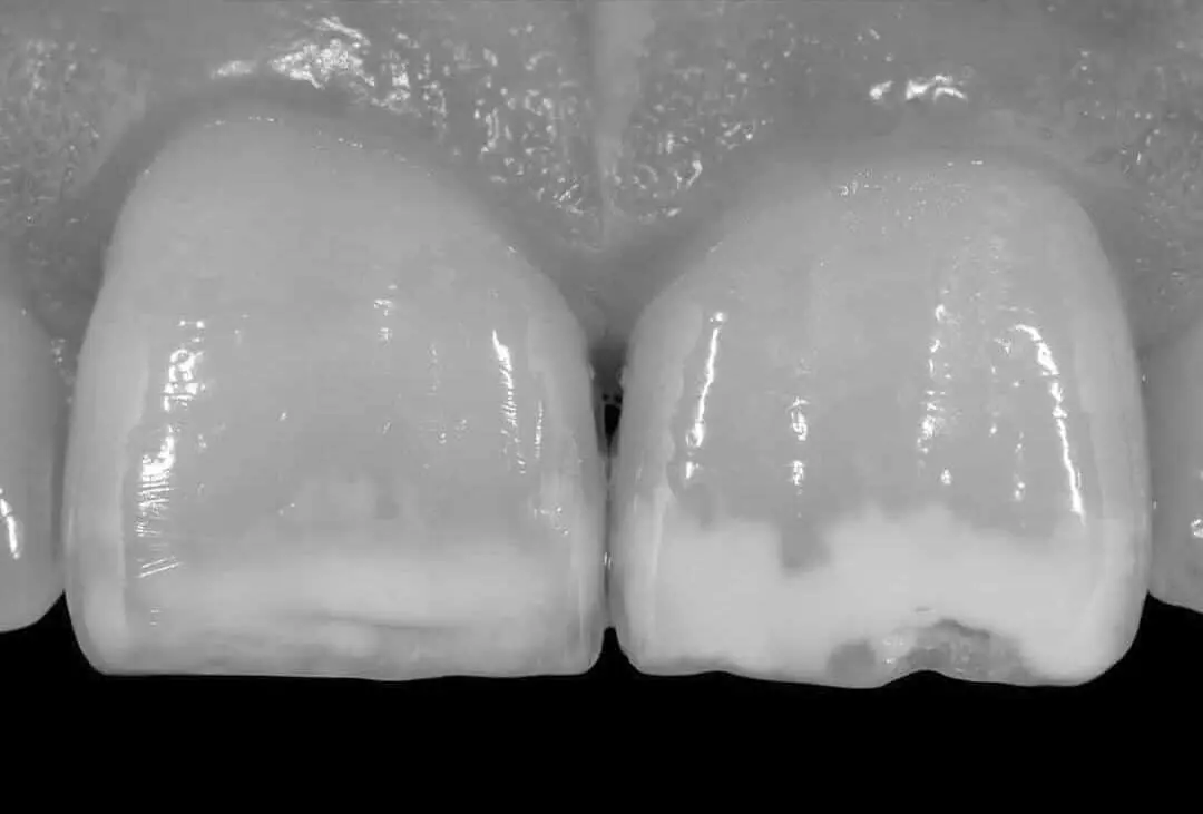 diente manchado de blanco - Qué hacer si tengo una mancha blanca en el diente