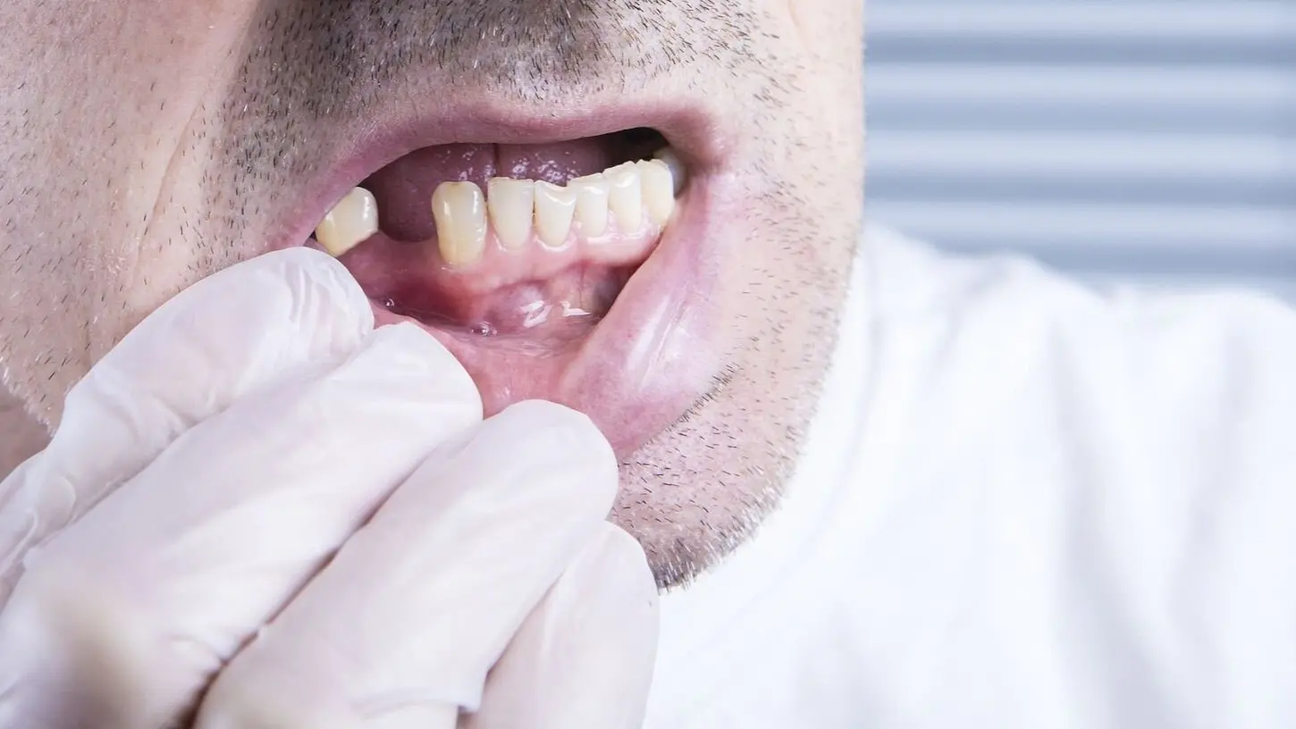 a que edad se caen los dientes en adultos - Qué pasa cuando a una persona se le caen los dientes