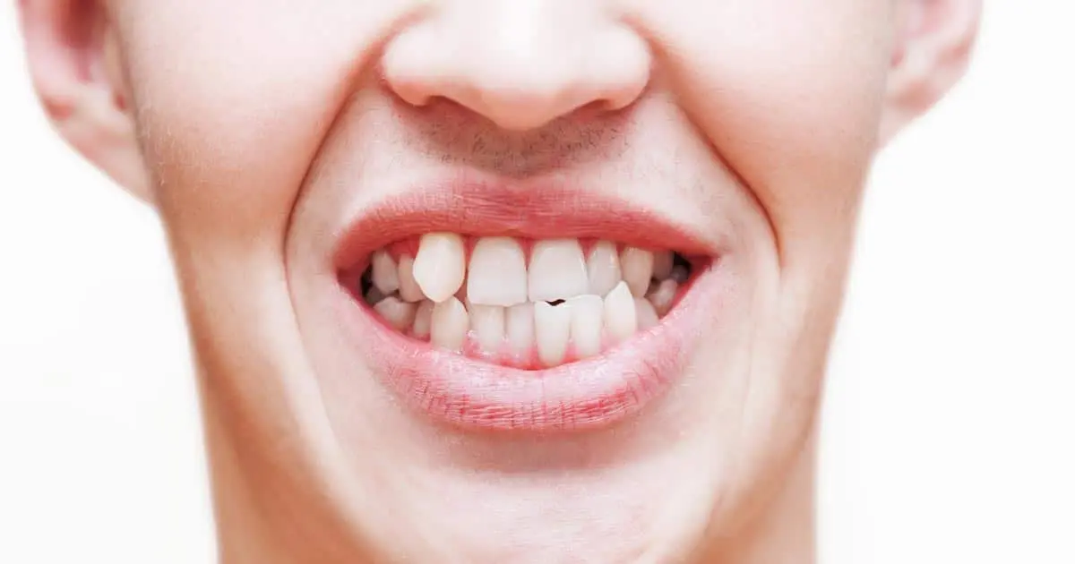 dientes chuecos - Qué pasa si no te arreglas los dientes chuecos