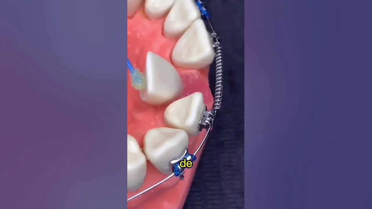 dientes detrás de otros solución - Qué pasa si salen los dientes permanentes detrás de los de leche