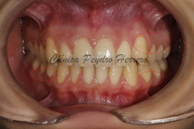 ortodoncia para pacientes con perdida de hueso - Qué pasa si tengo periodontitis y me pongo brackets