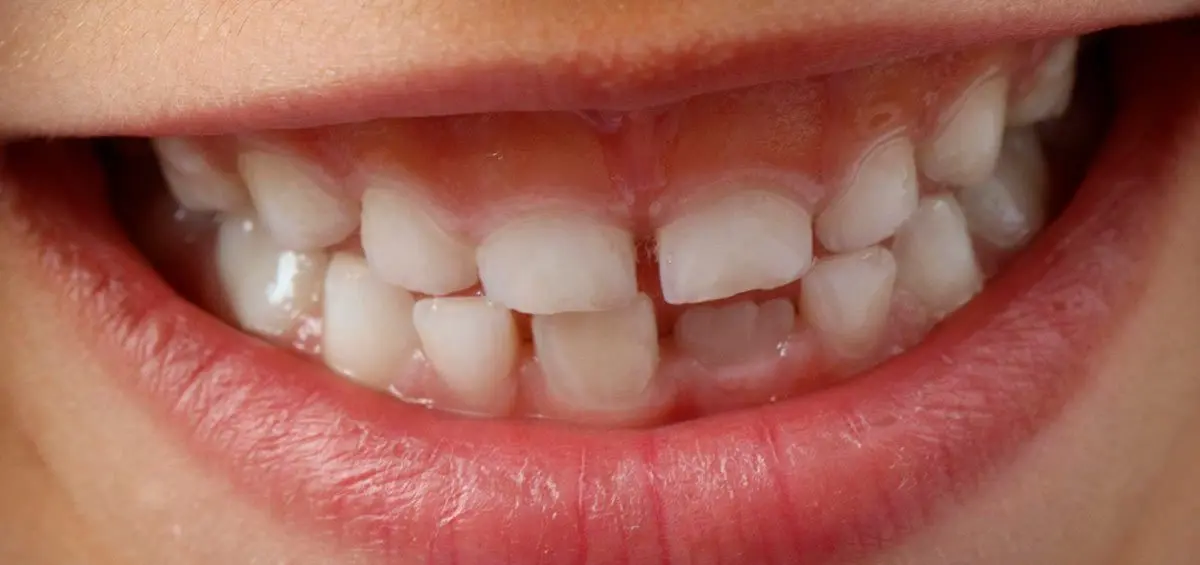 falta de calcio en los dientes de niños - Qué produce la falta de calcio en niños