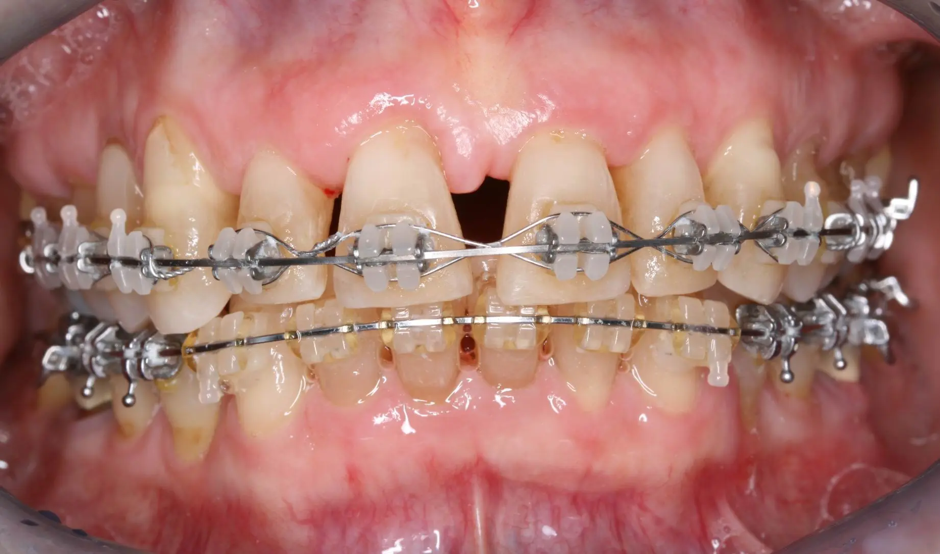 ortodoncia para pacientes con perdida de hueso - Qué se puede hacer cuando hay pérdida de hueso dental