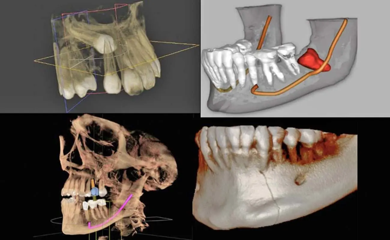 tomografia de dientes - Qué se puede ver en un TAC dental