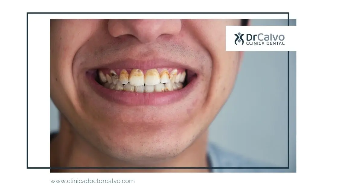 manchas en los dientes - Qué significa cuando te salen manchas en los dientes