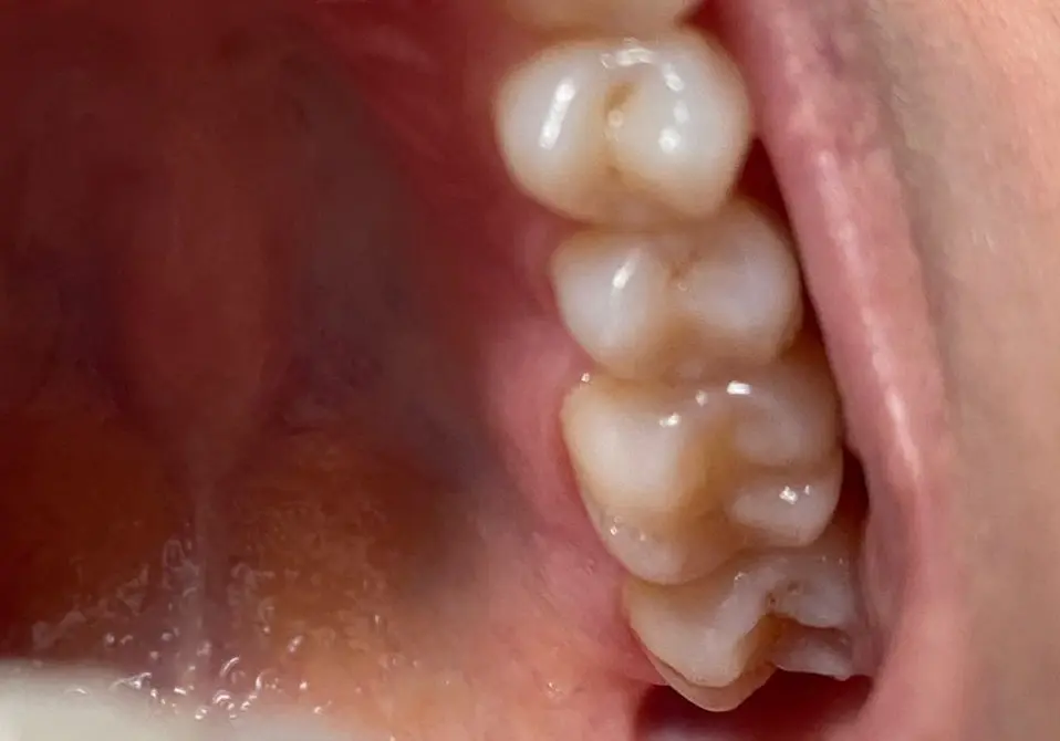 diente filtrado - Qué significa muela filtrada
