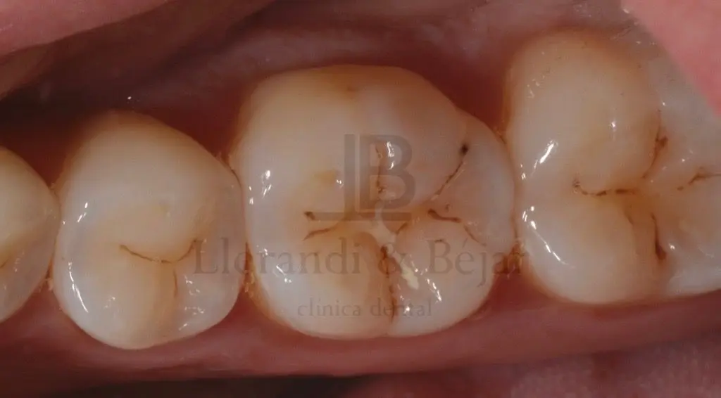 dientes picados - Qué significa tener los dientes picados