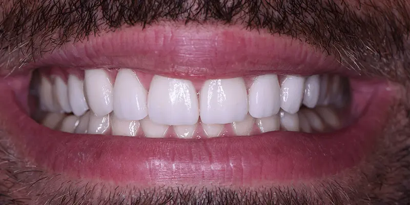 mascarilla de porcelana dientes - Qué son las carillas de porcelana para los dientes
