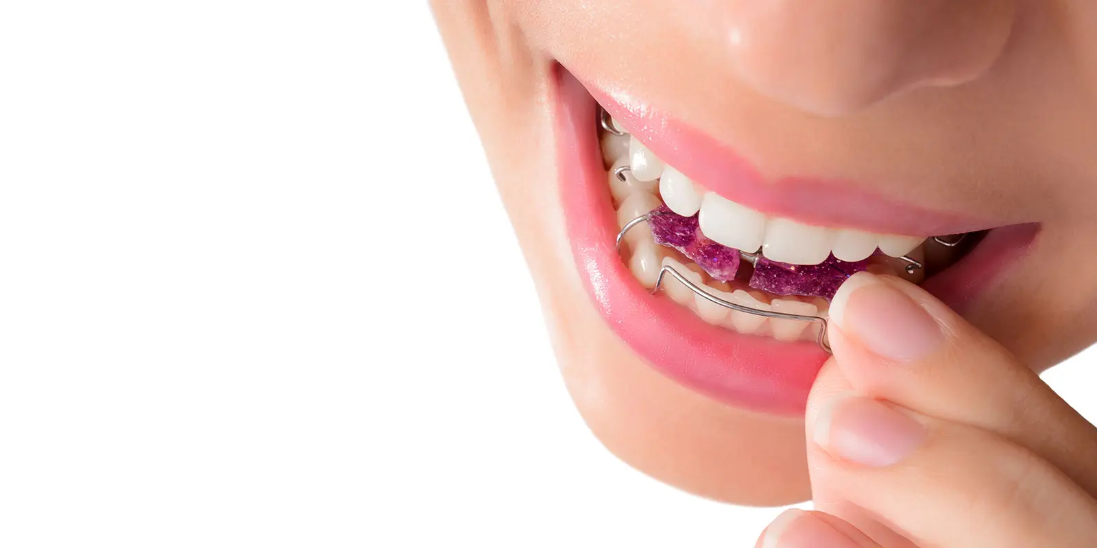 aparato funcional ortodoncia - Qué son los aparatos funcionales en ortodoncia