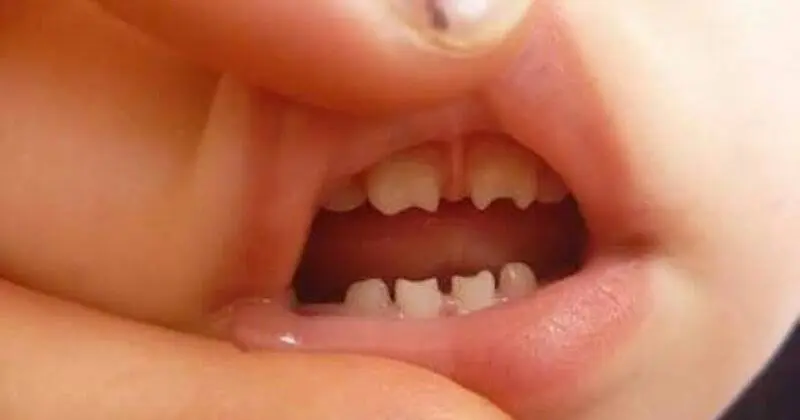 dientes cortos - Qué son los dientes de Hutchinson