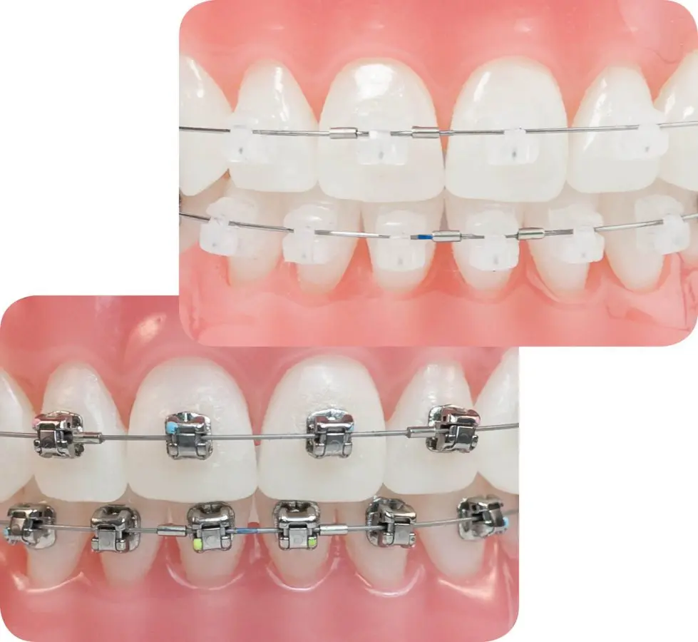 ortodoncia autoligable - Qué tan buenos son los brackets Autoligables