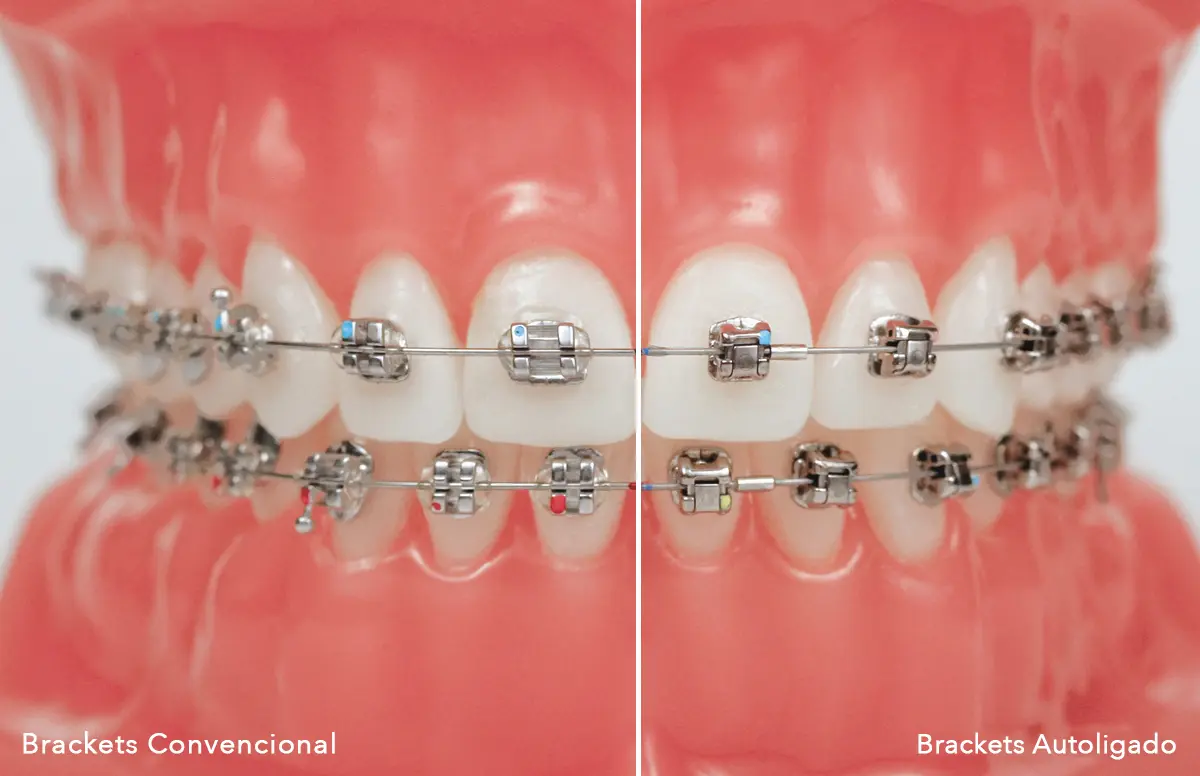 ortodoncia autoligado - Qué tan buenos son los brackets de autoligado