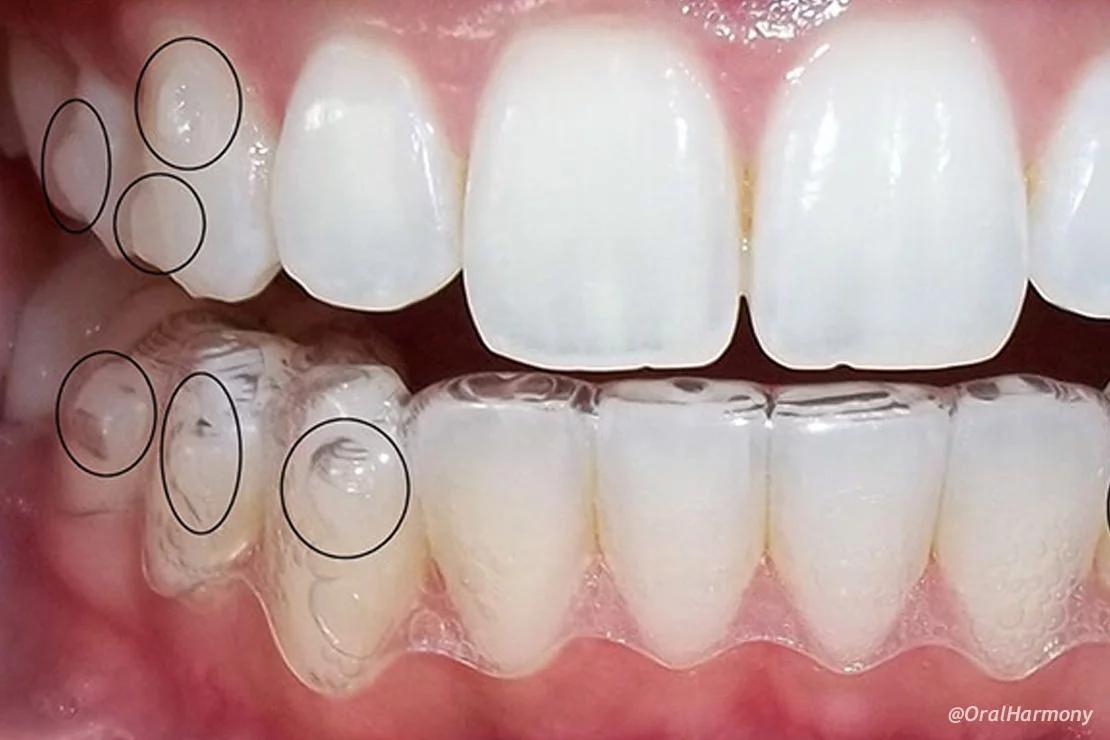 ortodoncia transparente - Qué tan buenos son los brackets transparentes