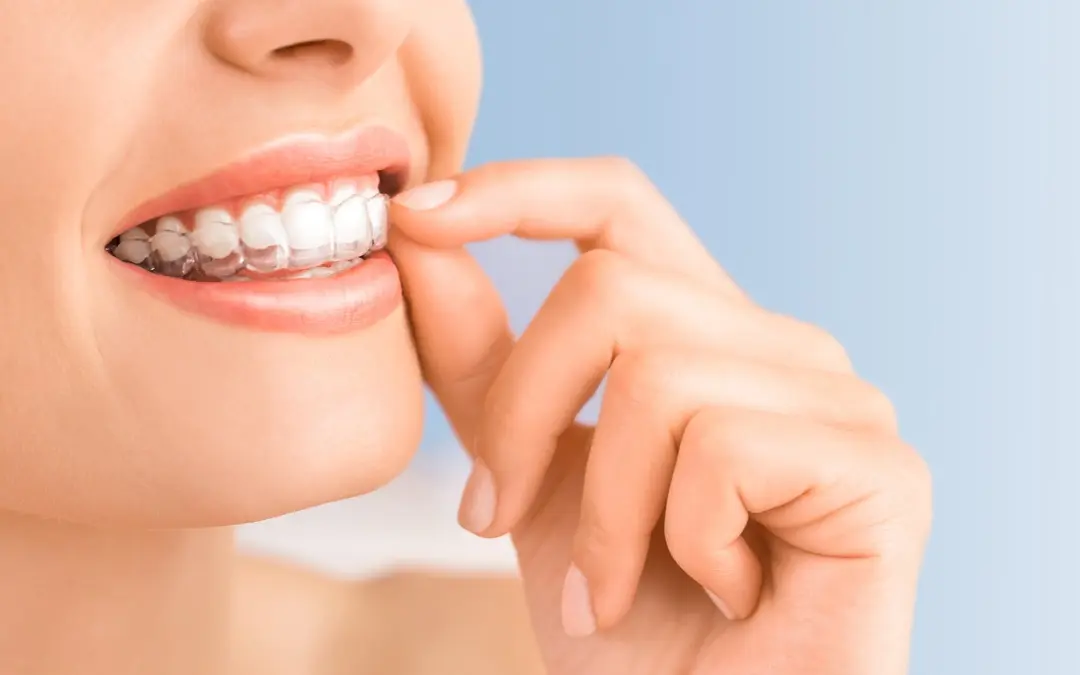aparato corrector de dientes - Qué tan efectivos son los alineadores dentales