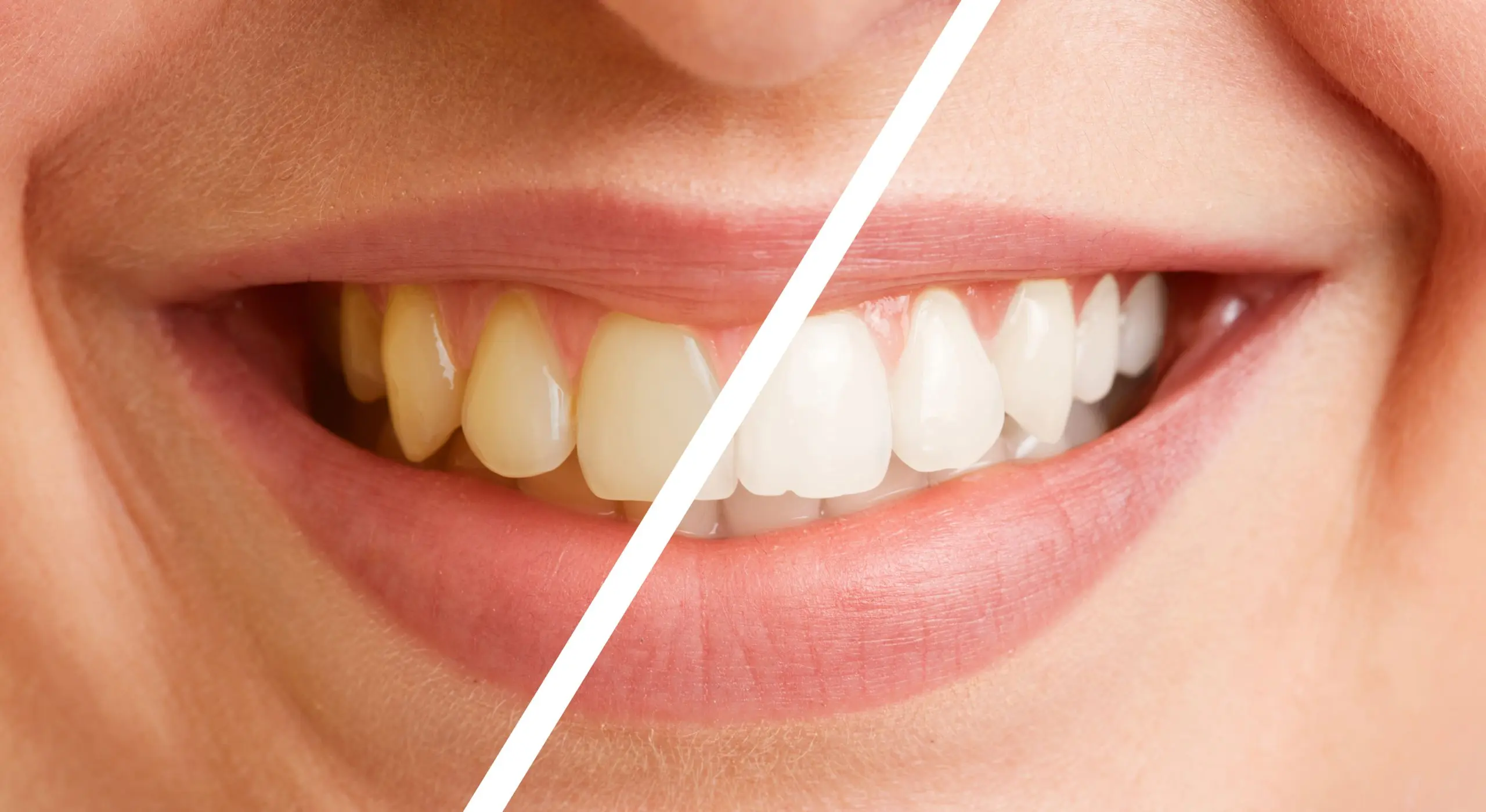 limpieza de dientes - Qué tipo de limpieza dental hay