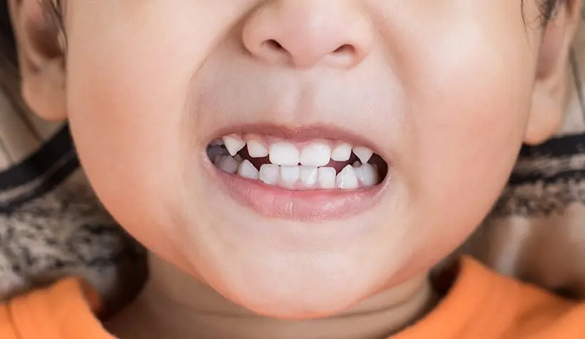 porque los niños rechinan los dientes - Qué tipo de parásito hace rechinar los dientes