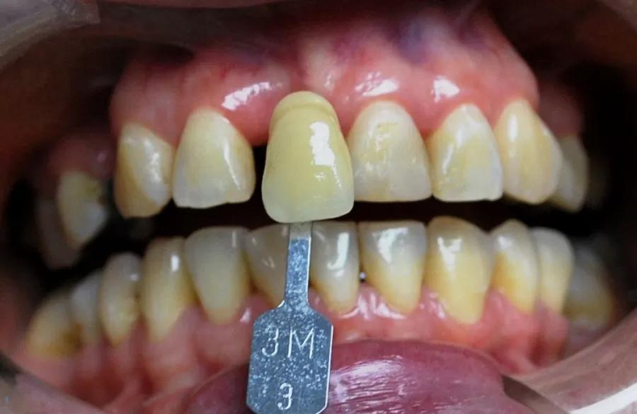 dientes postizos con ganchos - Qué tipo de prótesis dental es más recomendable