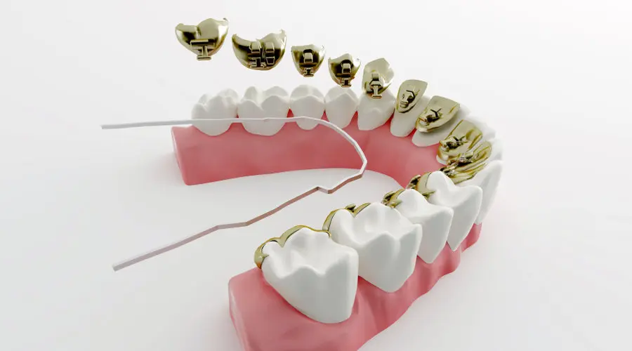 aparatos de ortodoncia removibles - Qué tipos de aparatos de ortodoncia existen