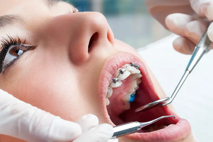 ortodoncia que es y para que sirve - Quién necesita una ortodoncia
